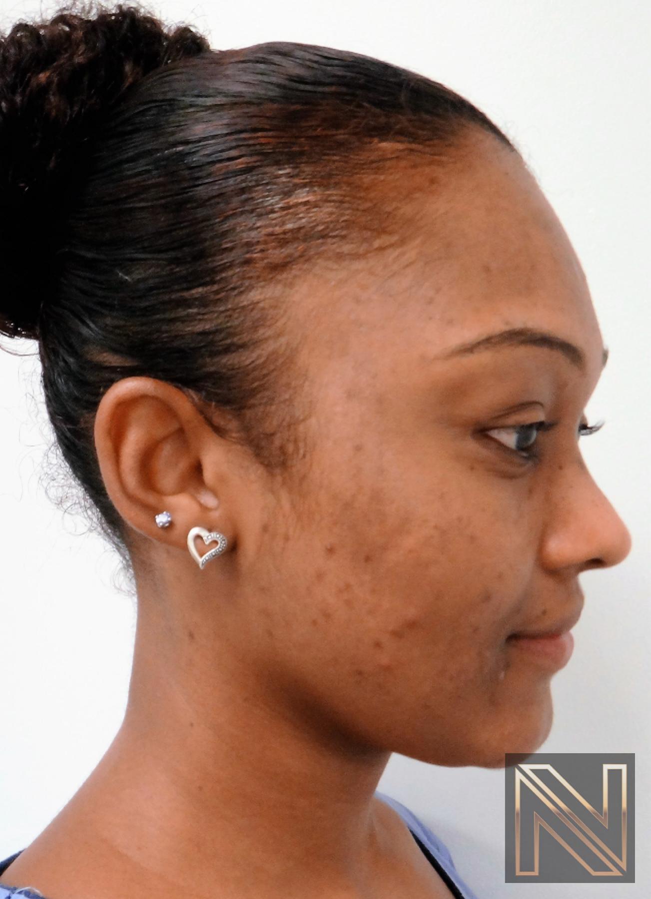 Laser Skin Resurfacing - Face: Patient 4 - After 2