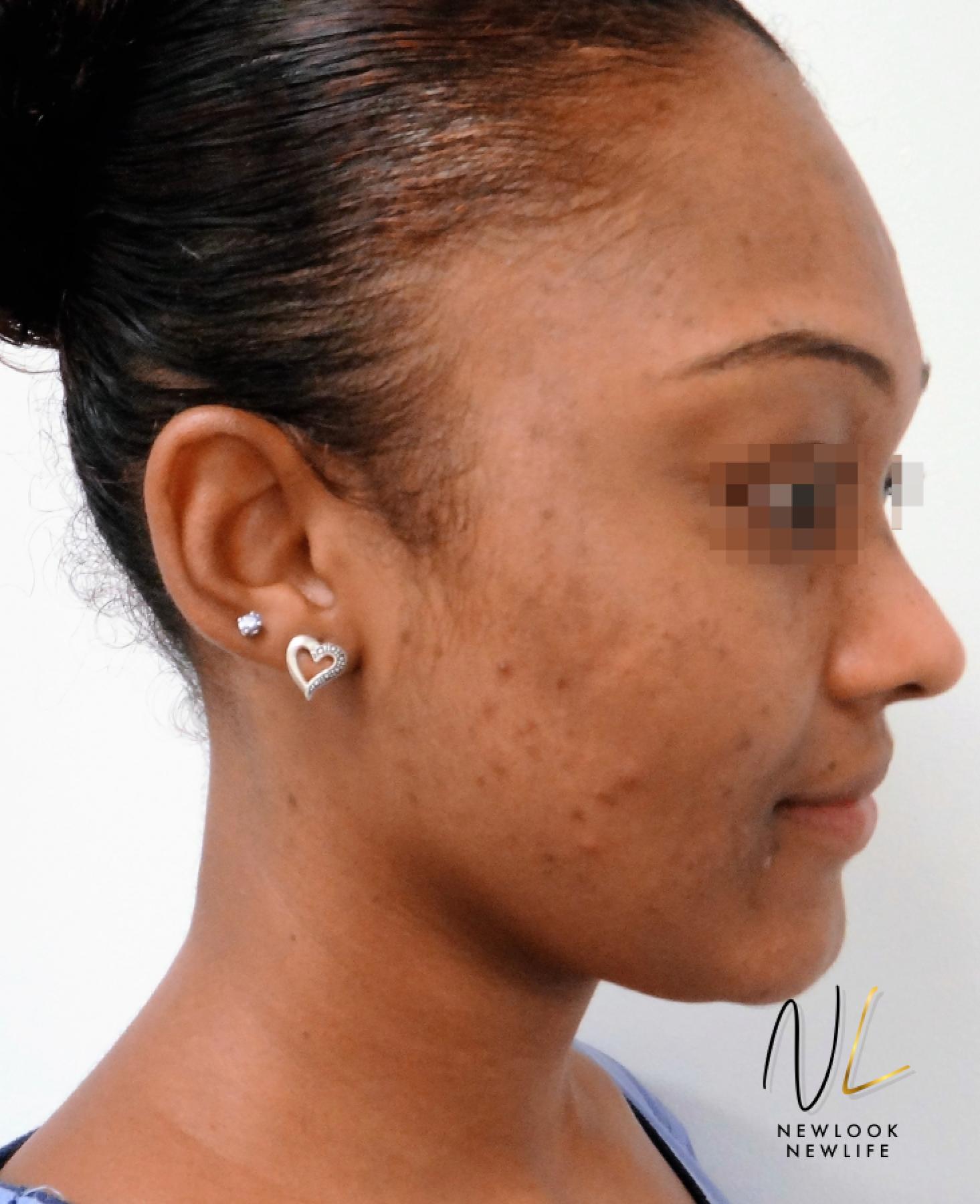 Laser Skin Resurfacing - Face: Patient 4 - After 2