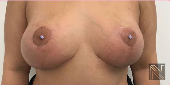 Breast Lift: Patient 9 - After  