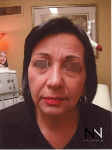 Liquid Facelift: Patient 5 - Before 