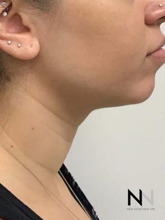 Liposuction: Patient 2 - After Image 1