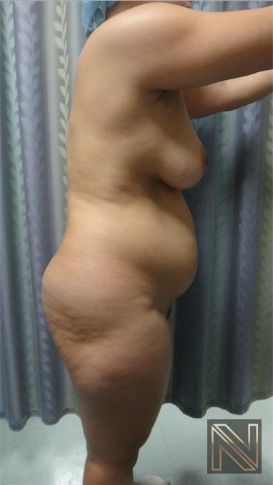 Liposuction: Patient 15 - Before 2
