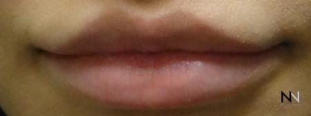 Fillers: Patient 7 - After Image 1