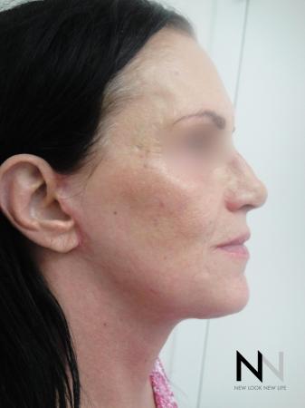 Fractional Resurfacing: Patient 1 - After Image 2