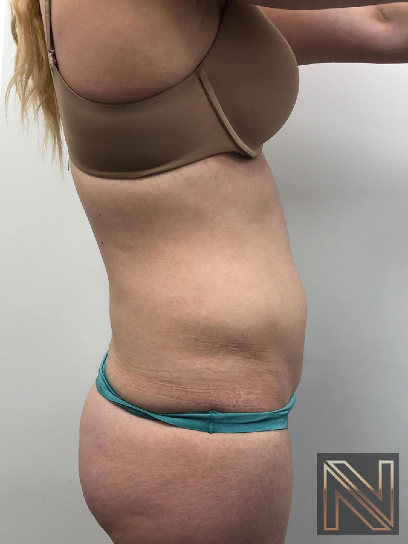 Liposuction: Patient 10 - Before 2