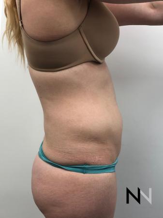 Liposuction: Patient 10 - Before Image 2