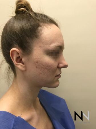 Fractional Resurfacing: Patient 4 - Before Image 2