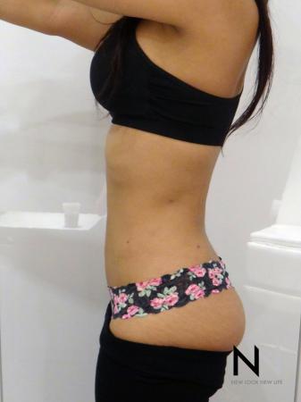 Liposuction: Patient 9 - After Image 3
