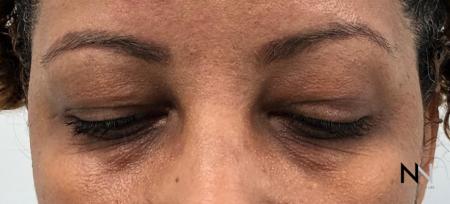 Blepharoplasty: Patient 1 - Before and After Image 2