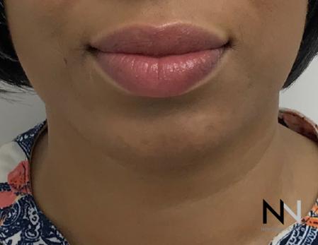 Chin Augmentation: Patient 3 - After Image 3
