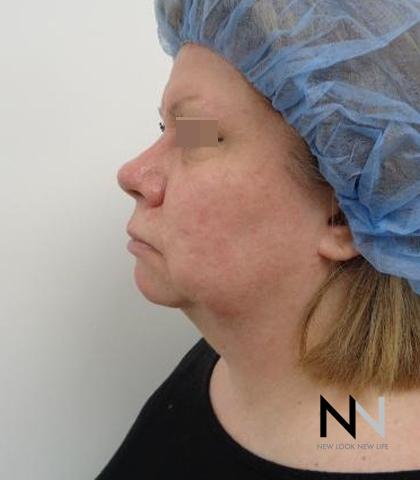 Fractional Resurfacing: Patient 2 - After 1