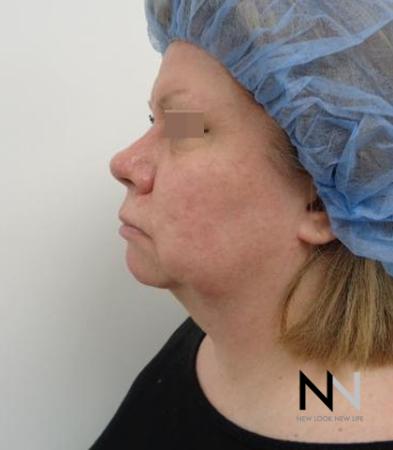 Fractional Resurfacing: Patient 2 - After Image 1