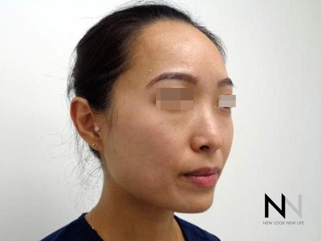 Laser Skin Resurfacing - Face: Patient 5 - Before and After 2