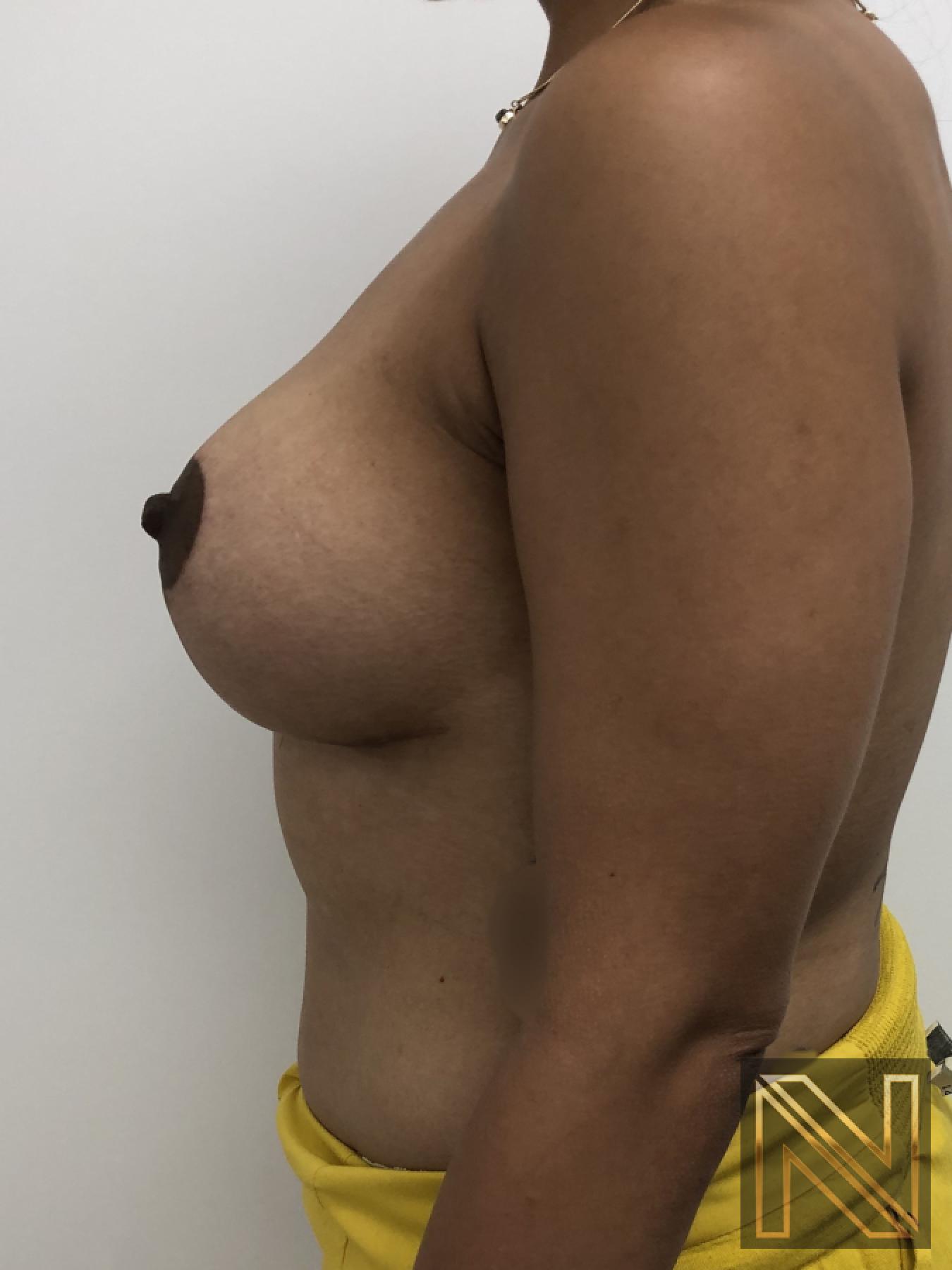 Breast Lift: Patient 1 - After 5