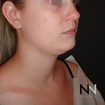 Liposuction: Patient 1 - Before Image 3