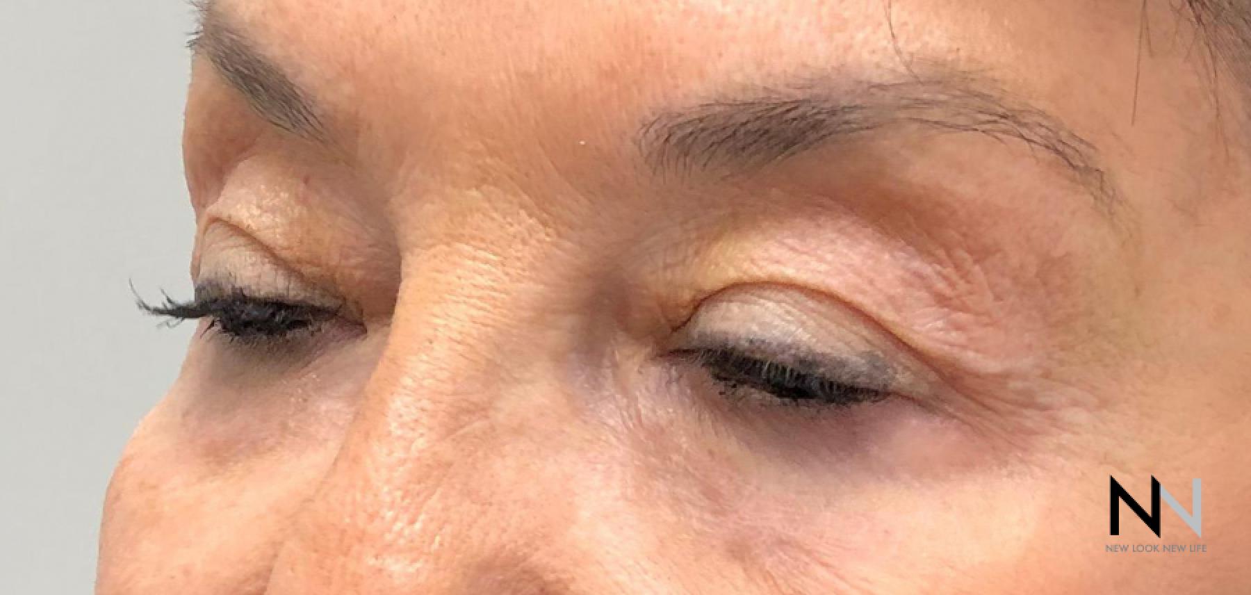 Fractional Resurfacing: Patient 7 - After  