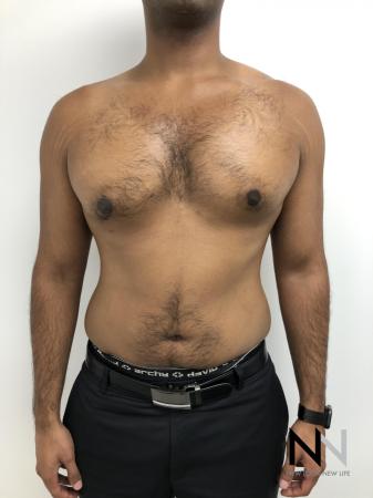 Gynecomastia: Patient 7 - After Image 1