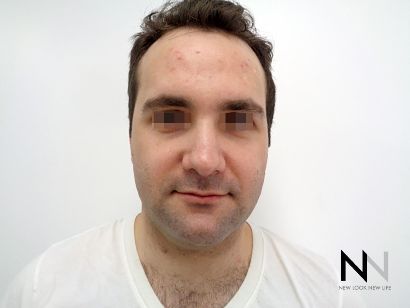 Laser Skin Resurfacing - Face: Patient 3 - Before 