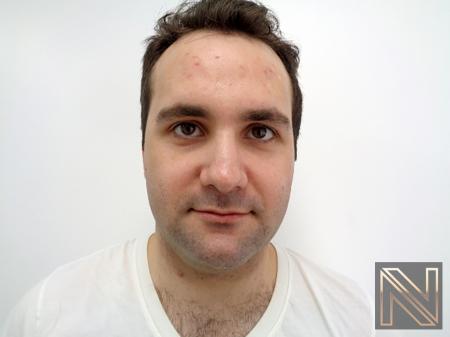Laser Skin Resurfacing - Face: Patient 3 - Before 
