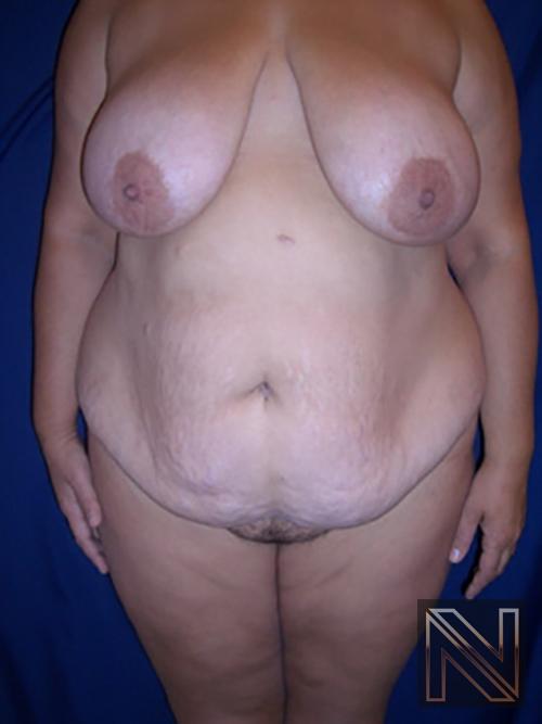 Abdominoplasty: Patient 4 - Before 1