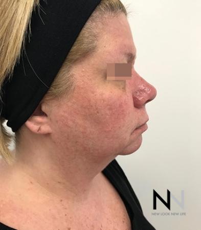 Fractional Resurfacing: Patient 2 - Before Image 4