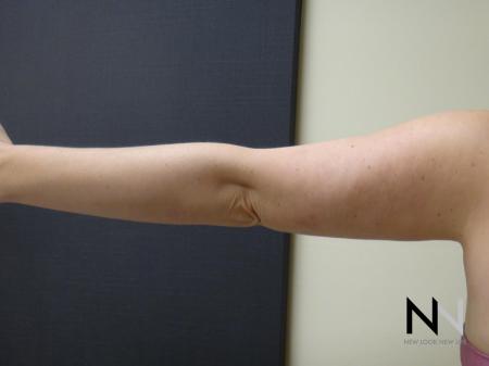 Liposuction: Patient 24 - After Image 1