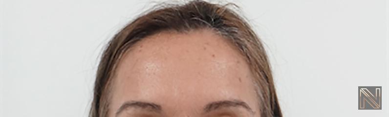 BOTOX® Cosmetic: Patient 6 - After 1
