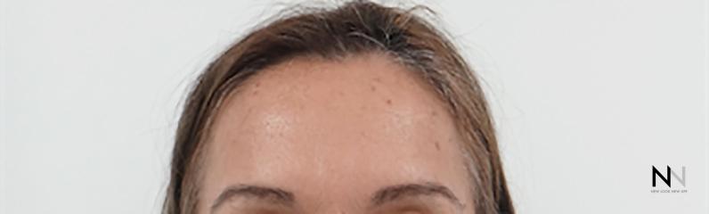 BOTOX® Cosmetic: Patient 6 - After  