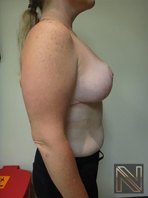 Breast Reduction: Patient 9 - After 5