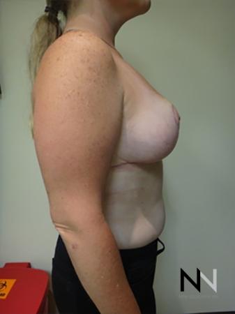 Breast Reduction: Patient 9 - After Image 5
