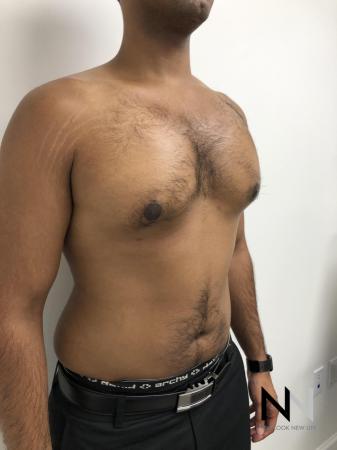 Gynecomastia: Patient 7 - After Image 4