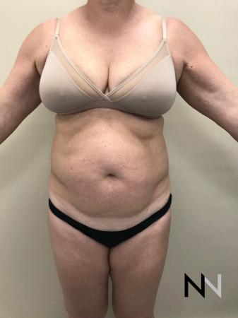 Liposuction: Patient 11 - Before Image 1
