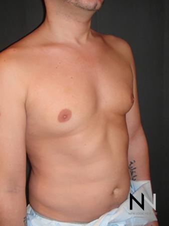 Gynecomastia: Patient 2 - Before Image 3