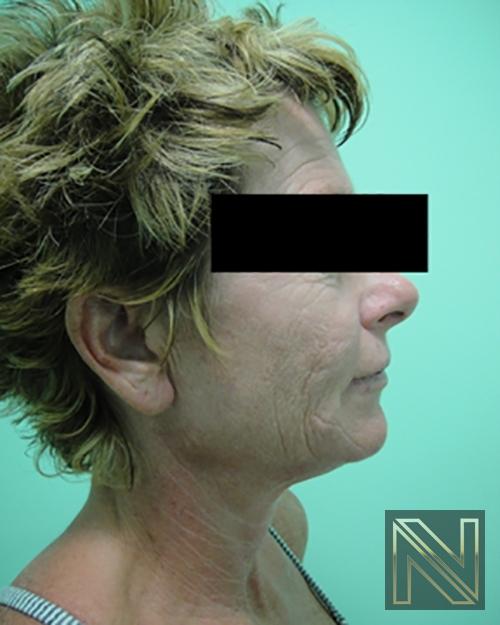 Facelift/Mini Facelift: Patient 10 - Before and After 5