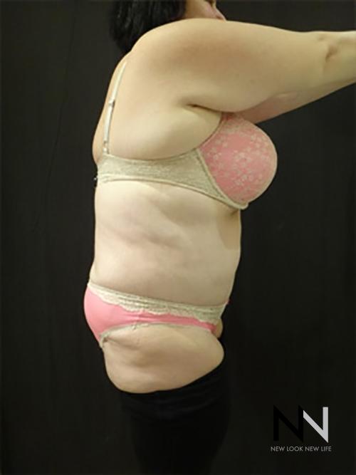 Abdominoplasty: Patient 15 - After 2