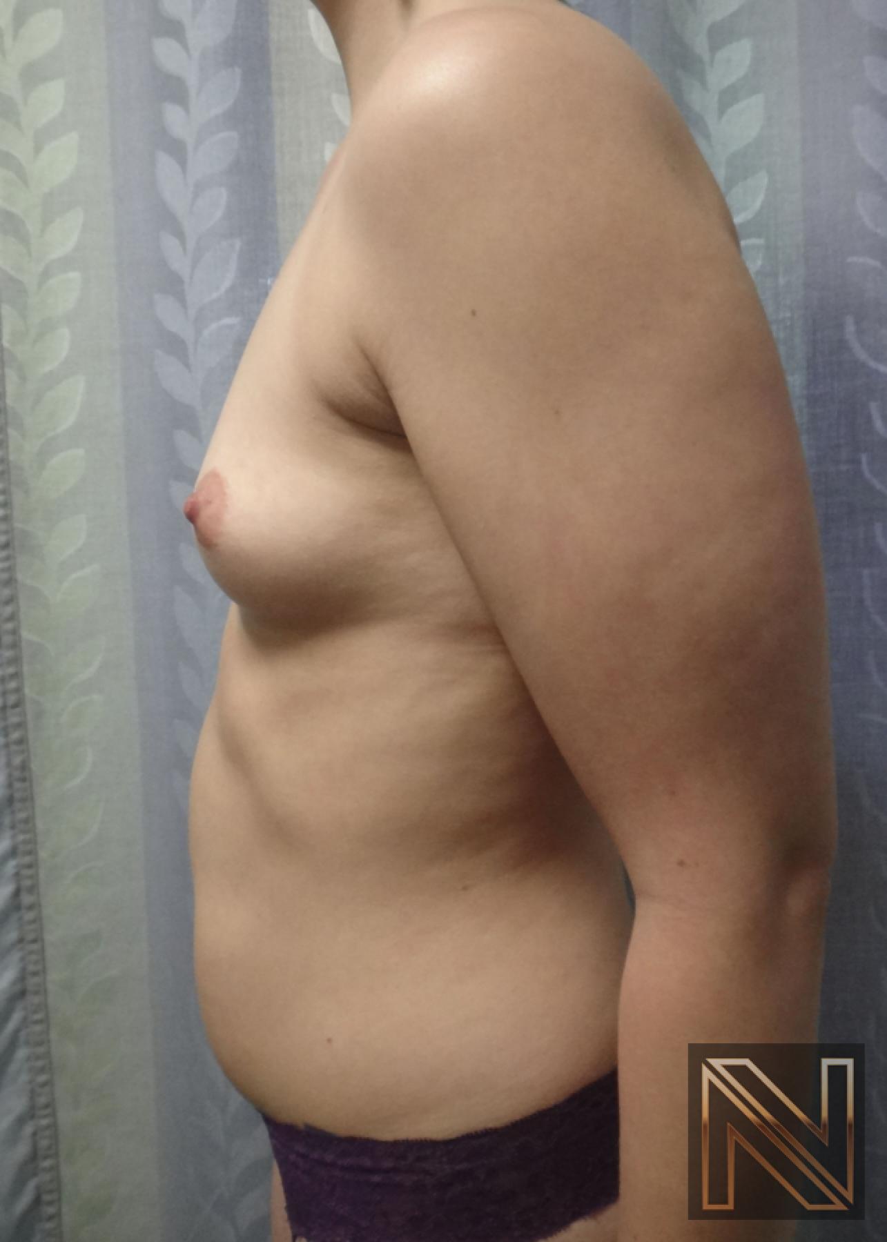 Breast Augmentation: Patient 15 - Before and After 5