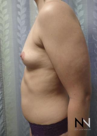 Breast Augmentation: Patient 15 - Before and After Image 5