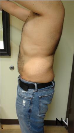 Liposuction: Patient 16 - After Image 2