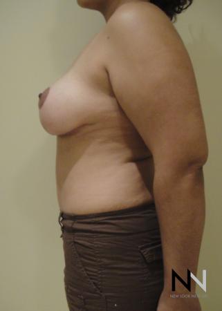 Breast Lift: Patient 6 - After Image 5