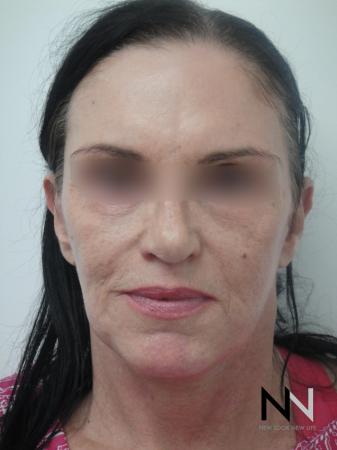 Fractional Resurfacing: Patient 1 - After Image 3