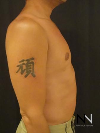 Gynecomastia: Patient 2 - After Image 5