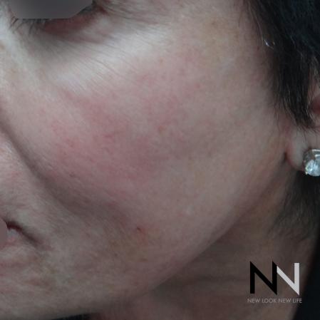 Halo™: Patient 4 - Before Image 1