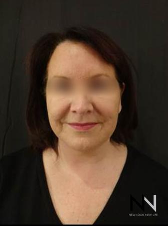 Facelift/Mini Facelift: Patient 4 - After Image 2