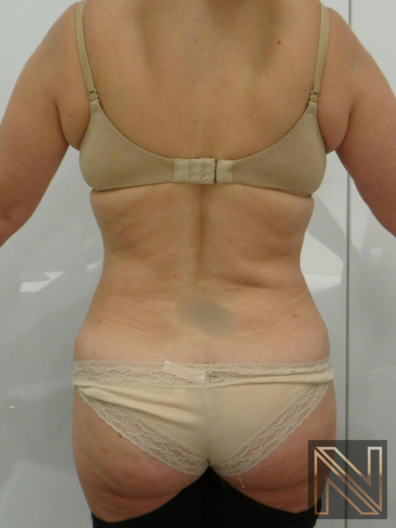 Liposuction: Patient 21 - After 1