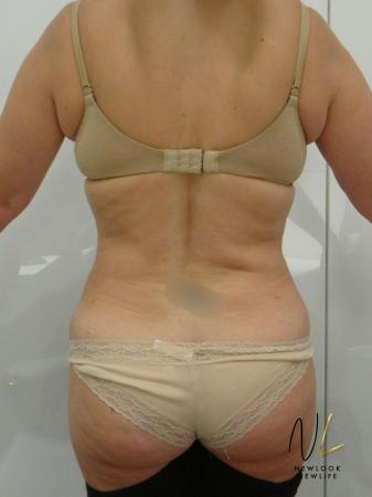 Liposuction: Patient 21 - After Image 1
