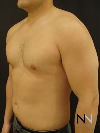 Gynecomastia: Patient 3 - After Image 2