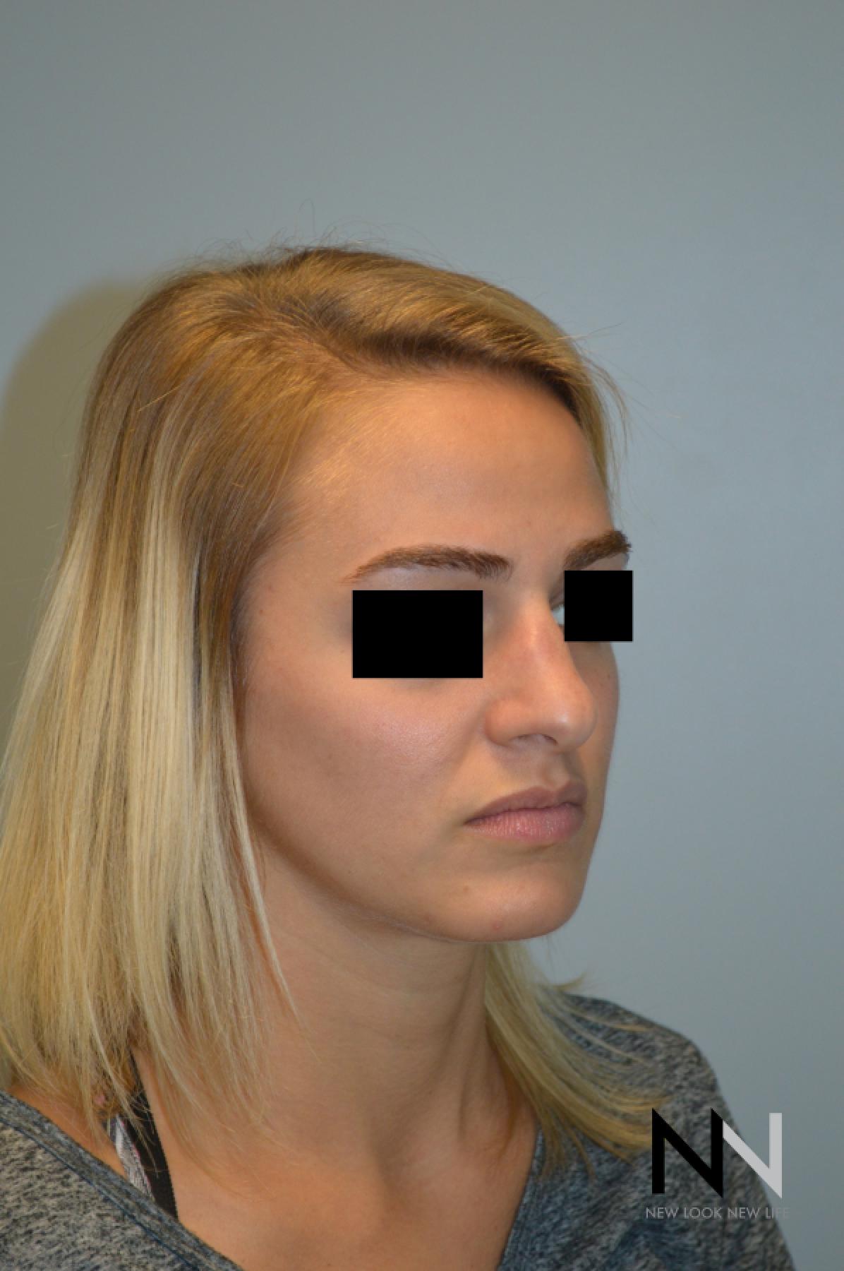 Rhinoplasty: Patient 3 - Before and After 3