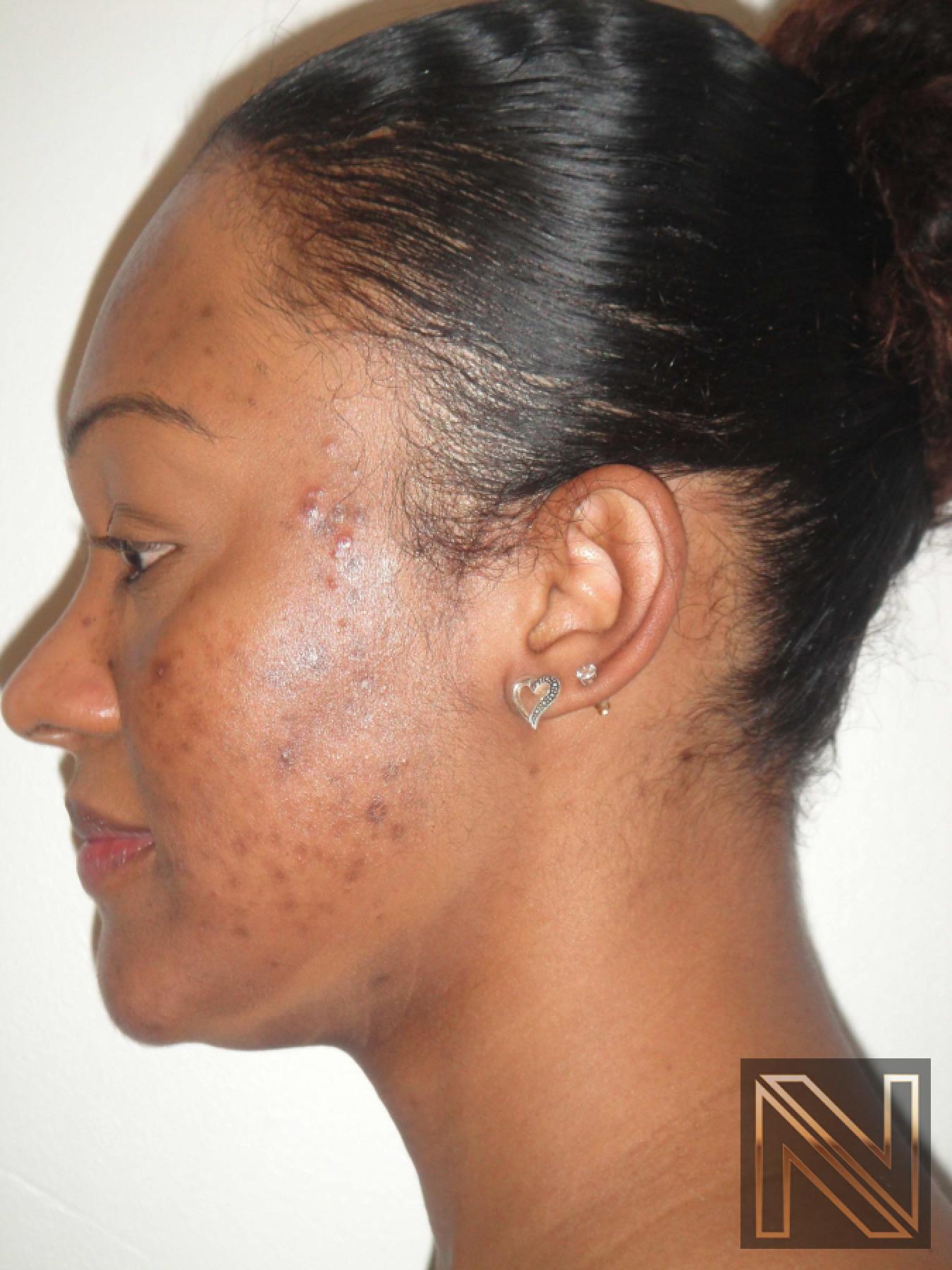 Laser Skin Resurfacing - Face: Patient 4 - Before and After 3
