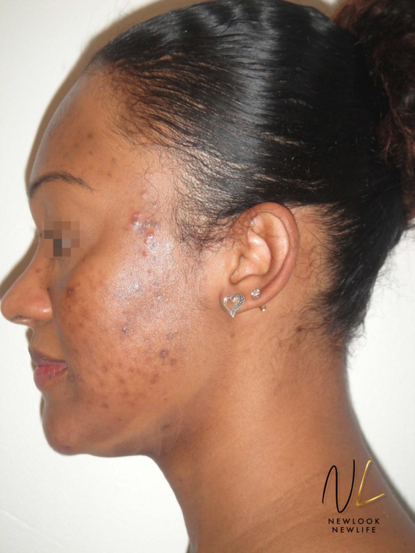 Laser Skin Resurfacing - Face: Patient 4 - Before and After 3