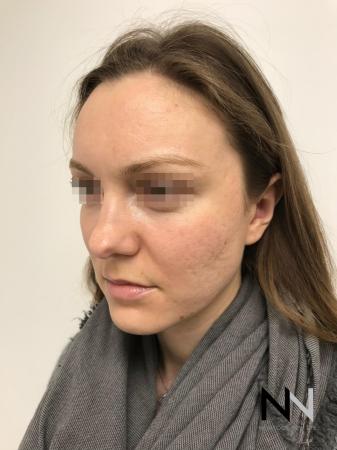 Fractional Resurfacing: Patient 4 - After Image 3